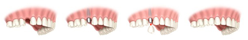 tiunite immediate dental implants