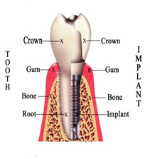 dental bangkok, dental cosmetic, dental clinic, dental crown, dental veneer, dentist bangkok, dental hospital, dental implants, invisalign bangkok, bangkok sukhumvit