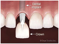 dental bangkok, dental cosmetic, dental clinic, dental crown, dental veneer, dentist bangkok, dental hospital, dental implants, invisalign bangkok, bangkok sukhumvit