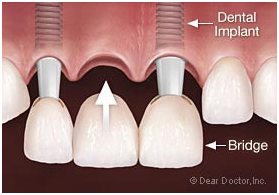 dental bangkok, dental cosmetic, dental clinic, dental crown, dental veneer, dentist bangkok, dental hospital, dental implants, invisalign bangkok, bangkok sukhumvit