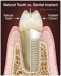 dental bangkok, dental cosmetic, dental clinic, dental crown, dental veneer, dentist bangkok, dental hospital, dental implants, invisalign bangkok, bangkok sukhumvit