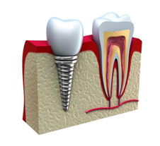 dental bangkok, dental cosmetic, dental clinic, dental crown, dental veneer, dentist bangkok, dental hospital, dental implants, invisalign bangkok, bangkok sukhumvit