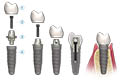 implant
