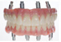 implant