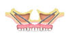 implant